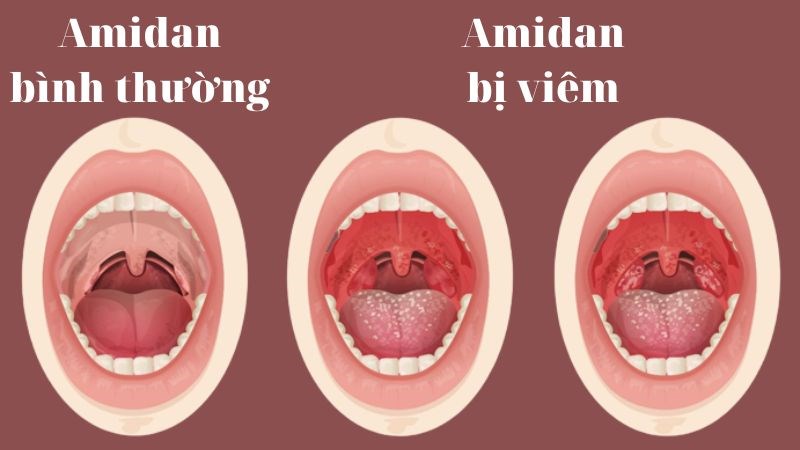 Viêm amidan là nguyên nhân gây đau họng